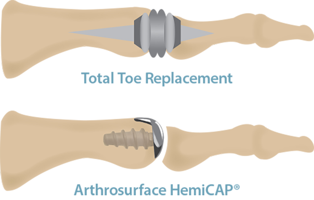 The Stiff Big Toe Joint (Hallux Rigidus)